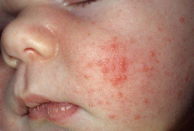 Neonatal acne