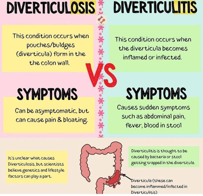 Diverticulitis Vs Diverticulosis