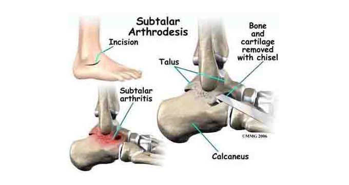 Subtalar Arthrodesis