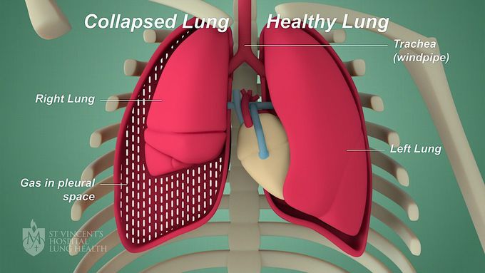 Pneumothorax