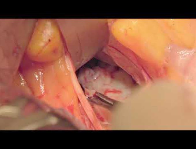 Hypertrophic obstructive cardiomyopathy septal myectomy and trans aortic mitral valve repair