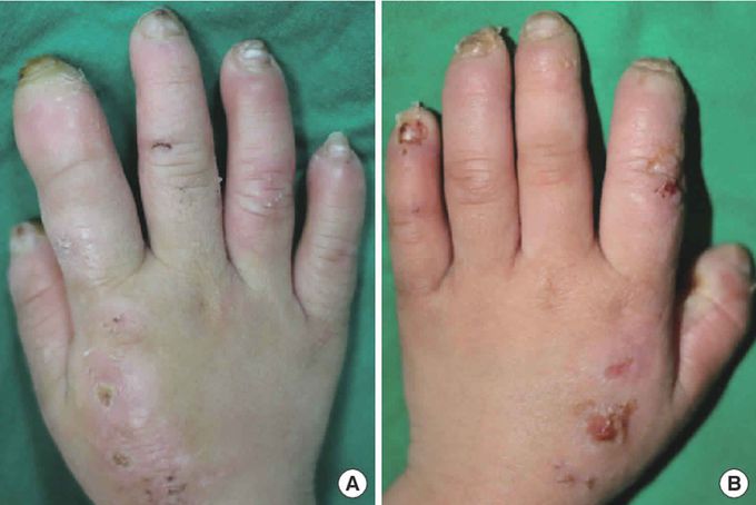 Congenital Insensitivity to Pain