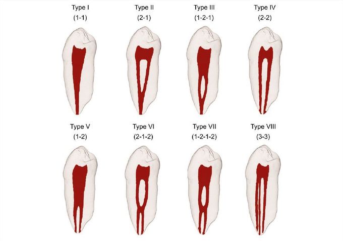 Vertucci’s classification for root canal morphology