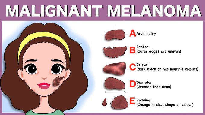 Melanoma as a skin disease