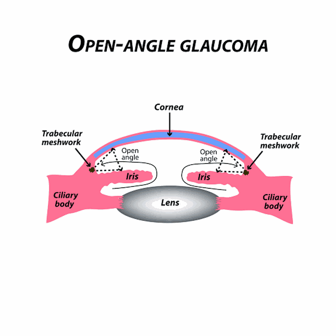 Open angle glaucoma