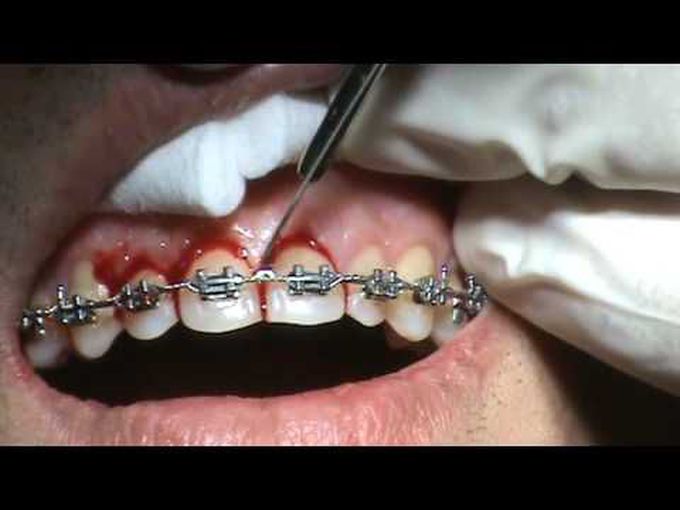 Supra-Crestal Fiberotomy