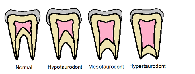Features of taurodontism