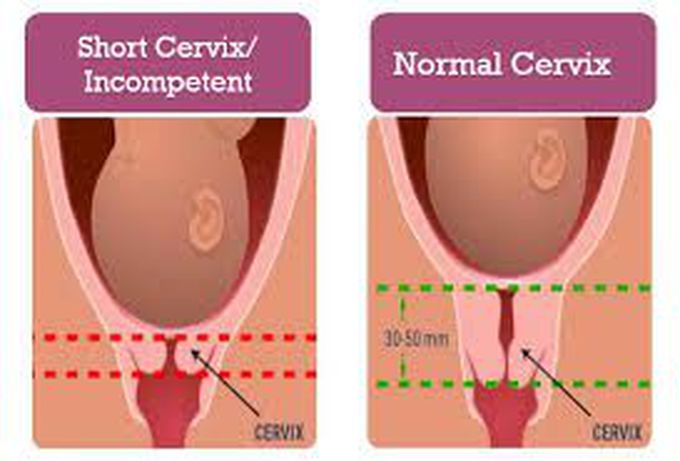 What are signs of incompetent cervix?