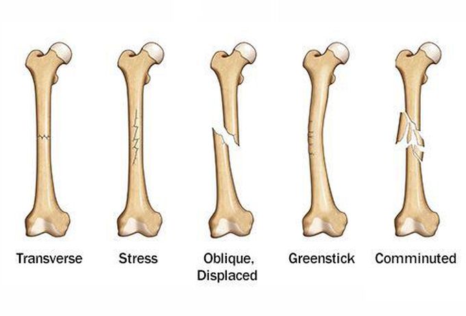Broken Bones
