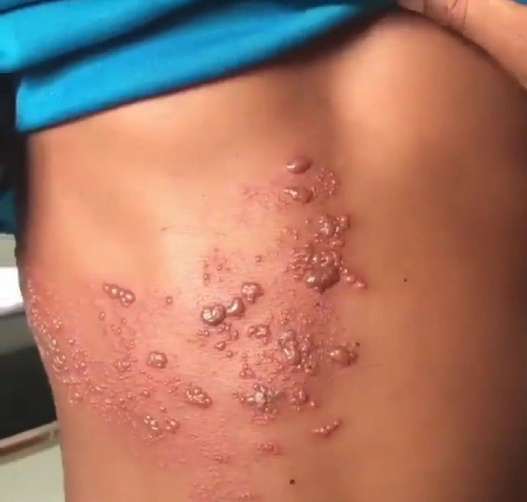 tuberculosis Caramelo vocal  la faja de la reina es contagiosa Lujo  Denso templado