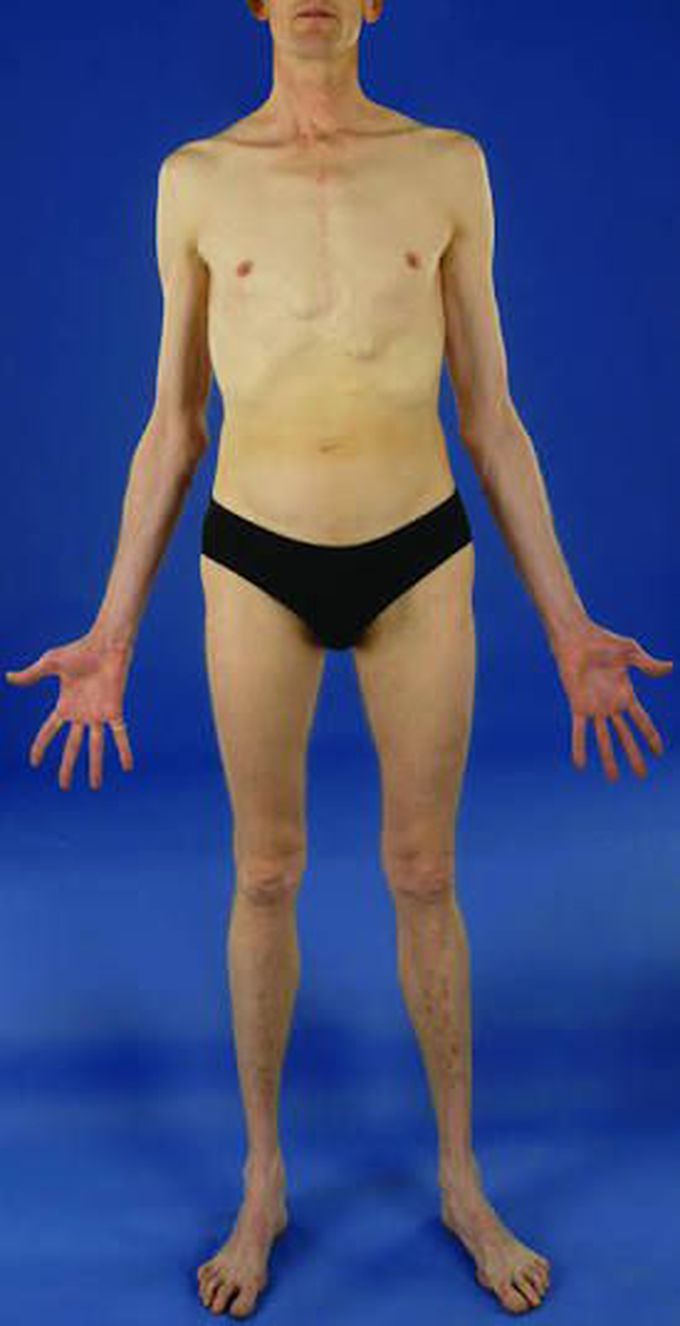 Marfan's Syndrome