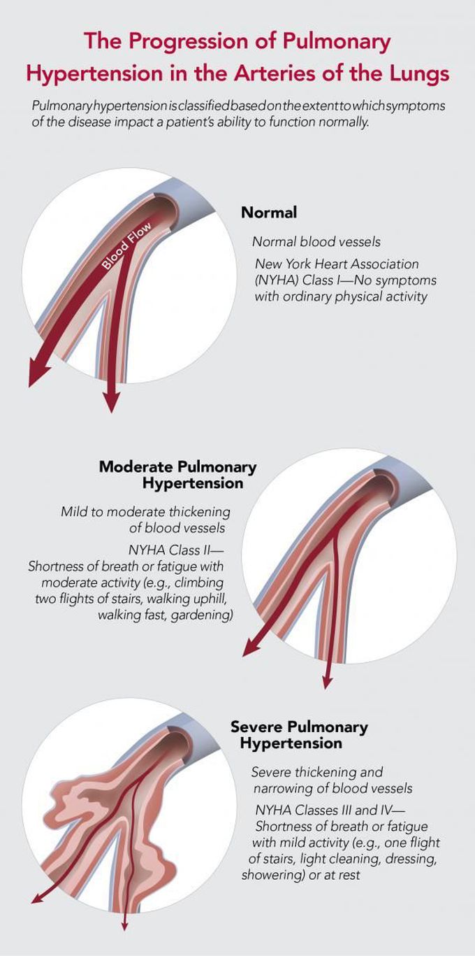Pin on Pulmonary Hypertension