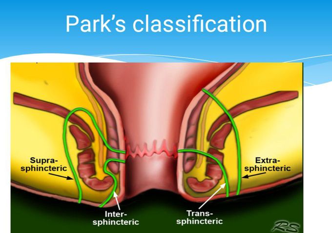 Park's Classification of Fistulas