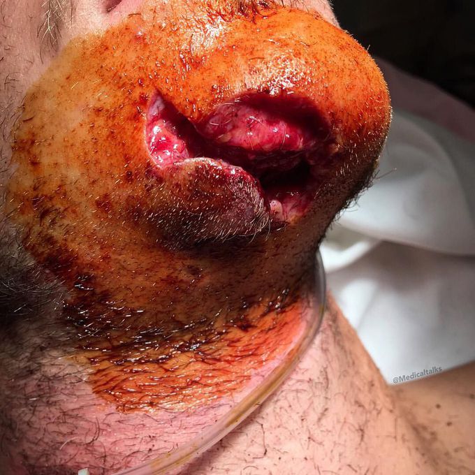 Laceration