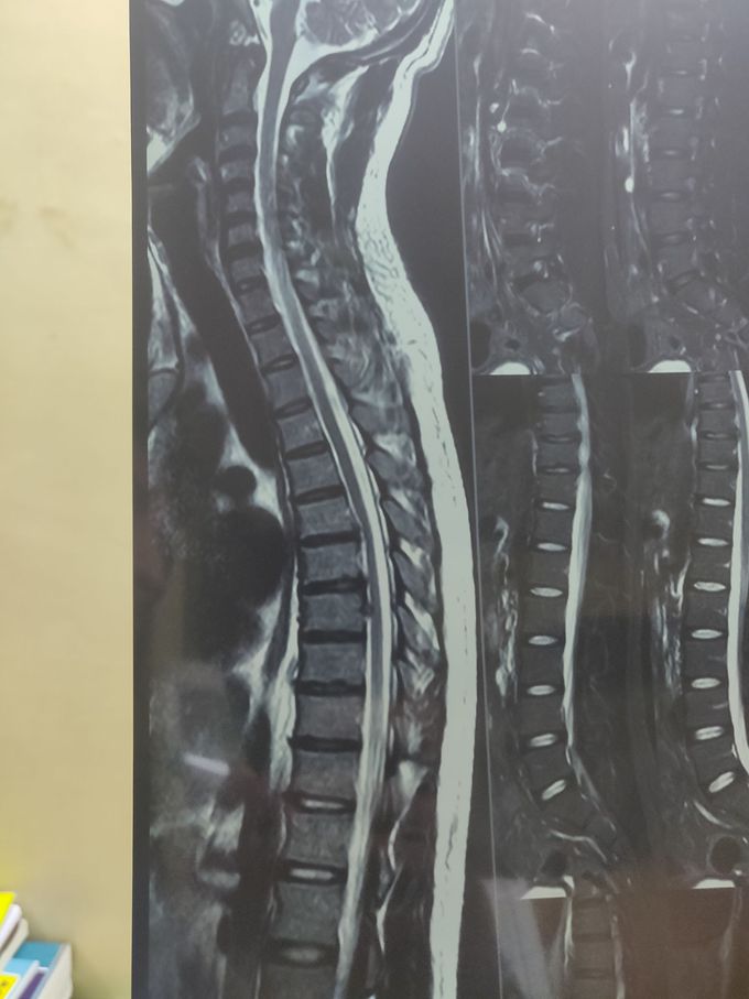 Dorsal Disc bulge