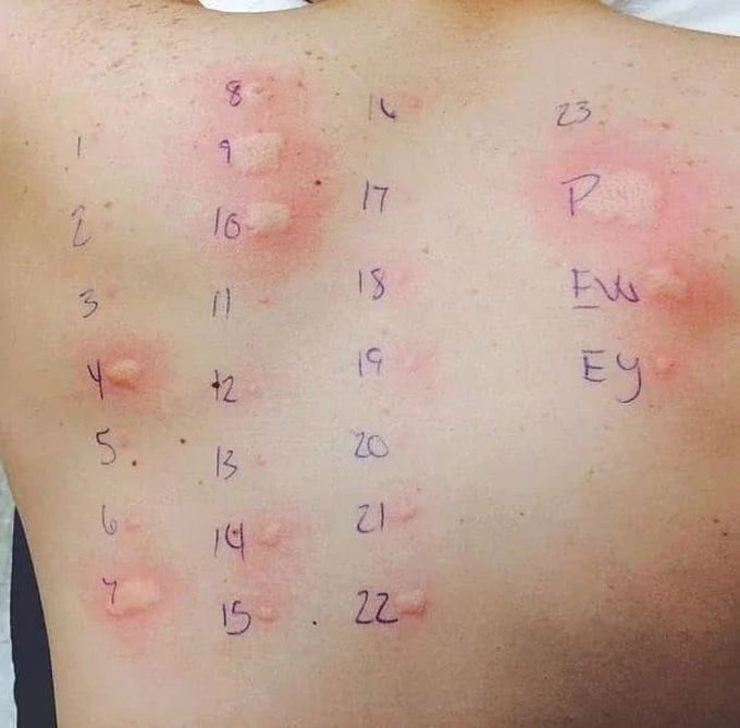 Skin Allergy Testing