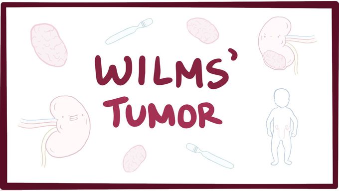 Wilms' tumor (nephroblastoma) - causes, symptoms, diagnosis, treatment & pathology