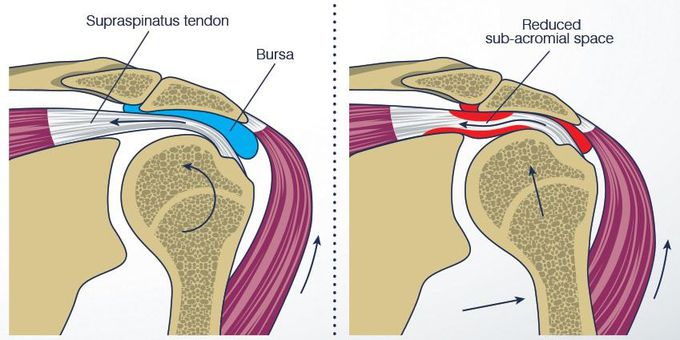 Symptoms of Shoulder Impingement Syndrome