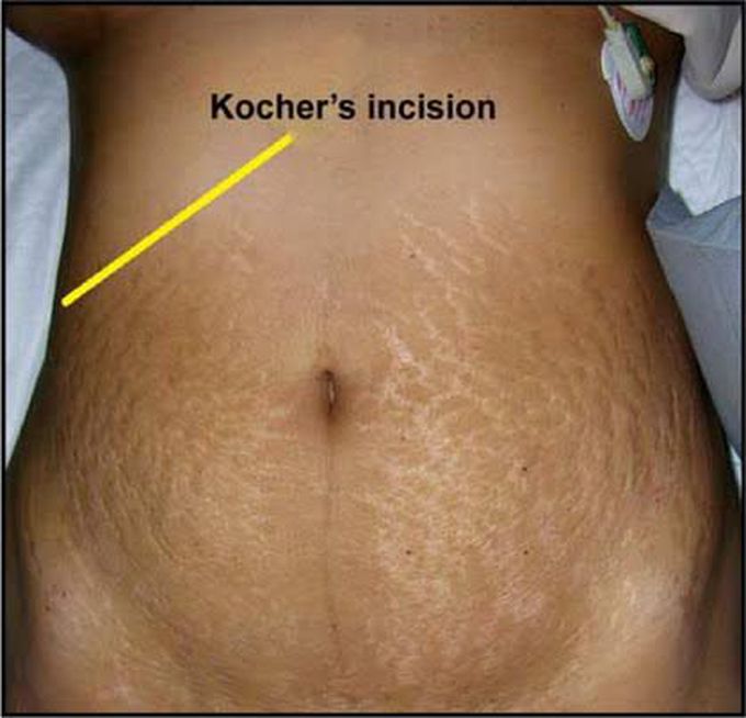Kocher incision