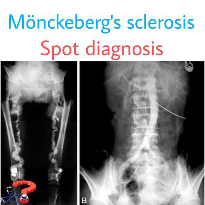 Mönckeberg's sclerosis
