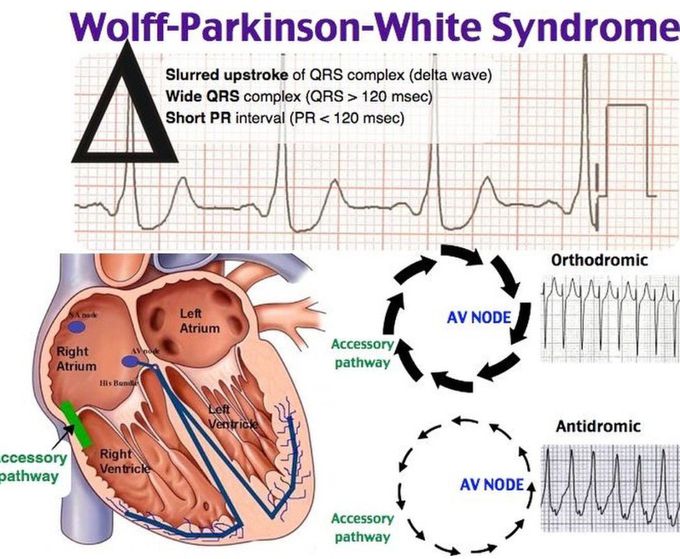 Wolff-Parkinson-White Syndrome