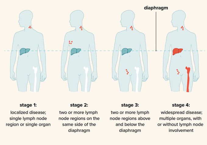 Cause of Non-Hodgkin's lymphoma