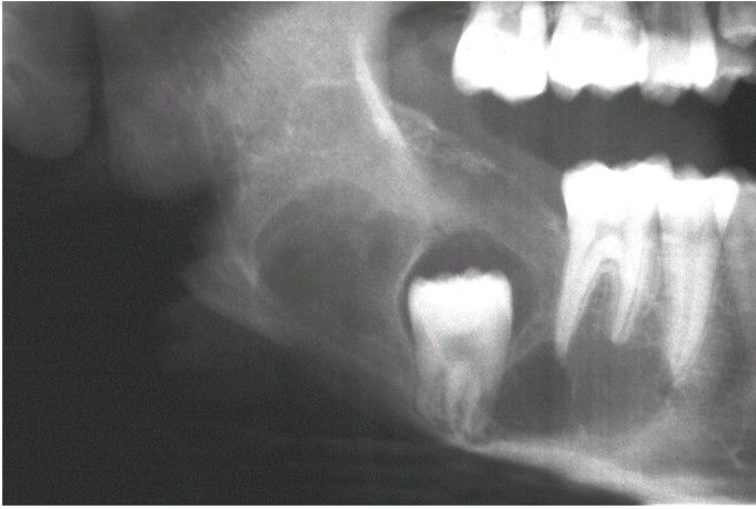 Ameloblastic Fibroma