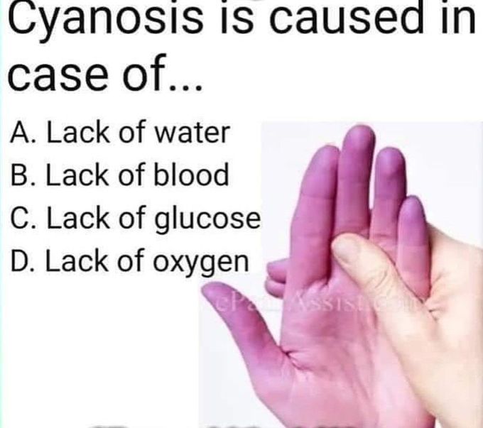 Cyanosis