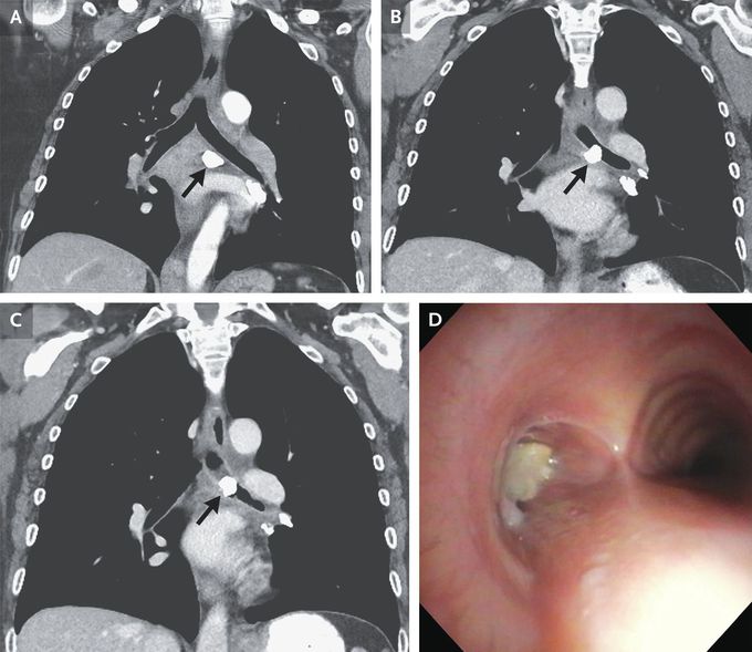 Broncholithiasis