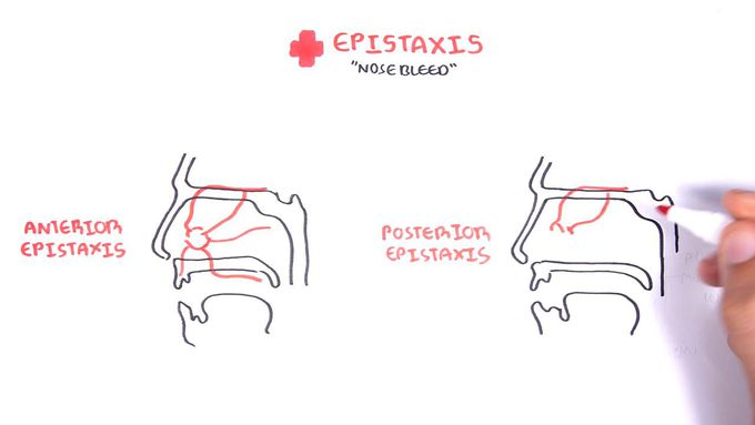 Clinical Anatomy -  Nasal Cavity and Nose bleeds