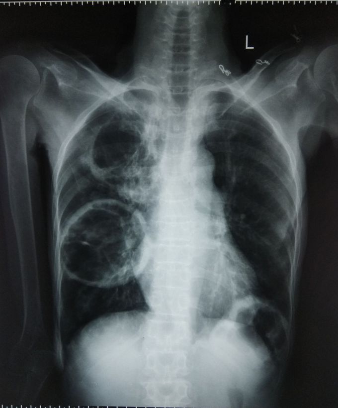 Chest Xray PA view MEDizzy