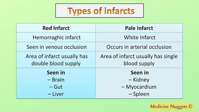 Types of infarct