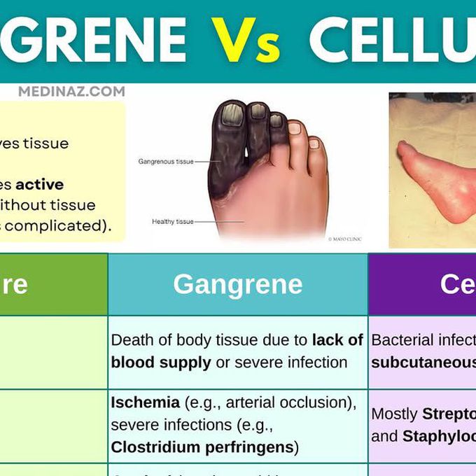 Cellulitis, gangrene