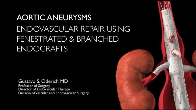 Treatment of Aortic Aneurysms-
Made easy
