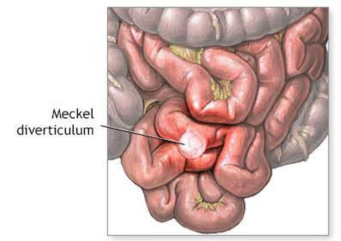 Causes of pelvic abscess