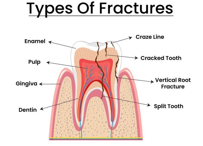 Types of Tooth Fracture