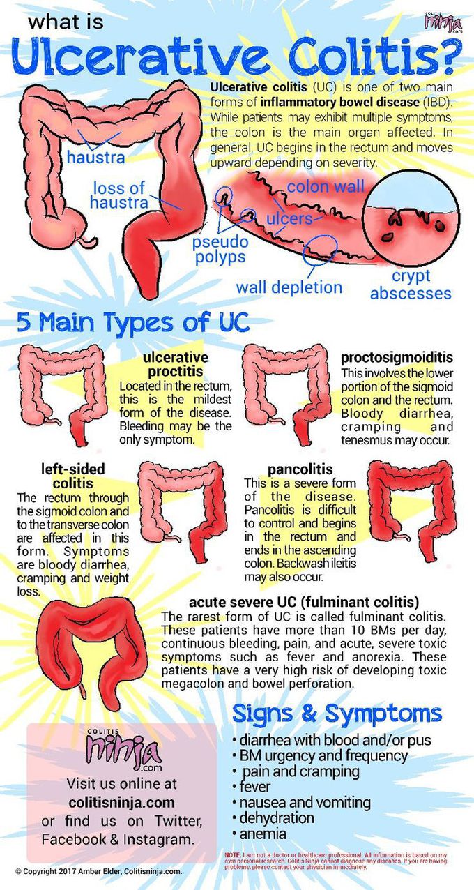 Ulcerative Colitis, UC