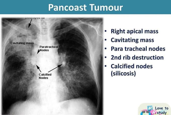 Pancoast tumor CXR