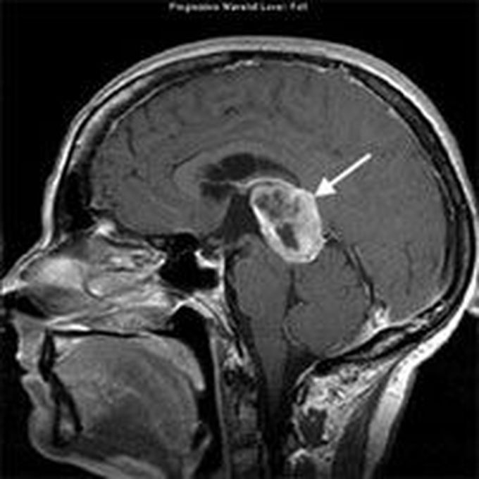 Pineal glands tumors