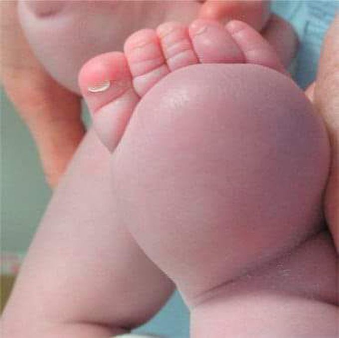 Milroy disease