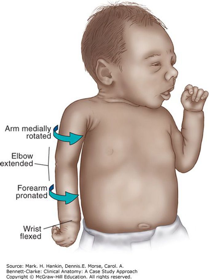 Erbs palsy
