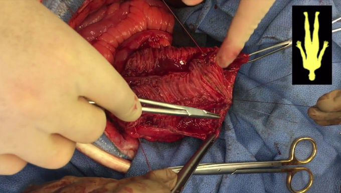 S-Pouch to the Rescue