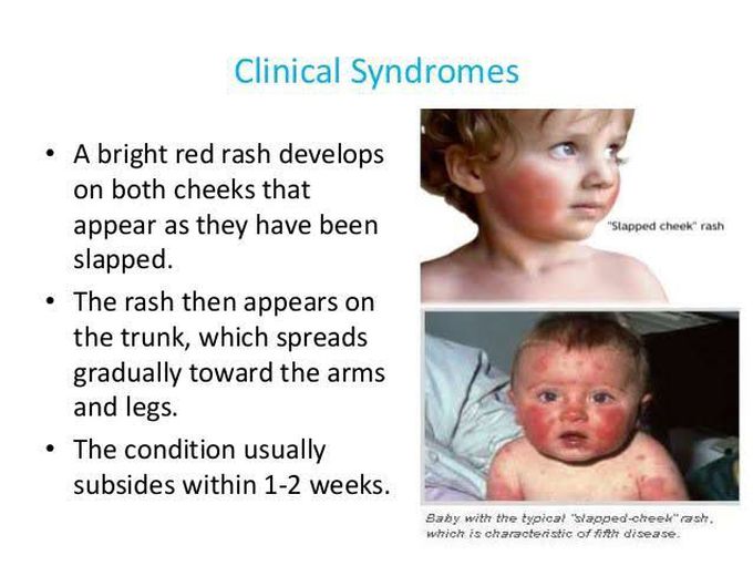 Erythema infectiosum symptoms