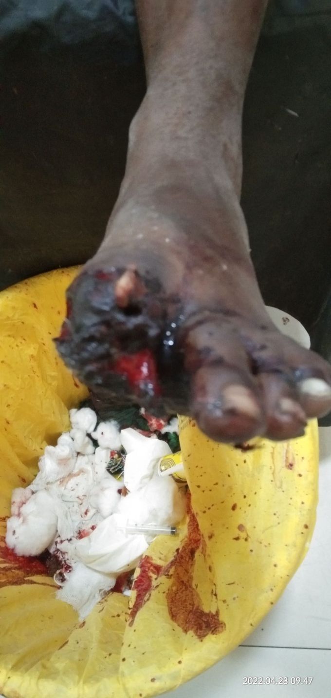 It is a toe finger  and to cut the toe