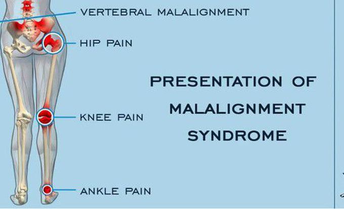 Treatment for Patellar malalignment