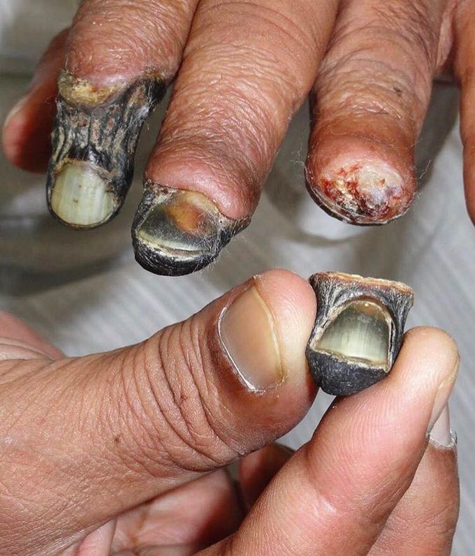 Dry gangrene of the fingertips due to frostbite!