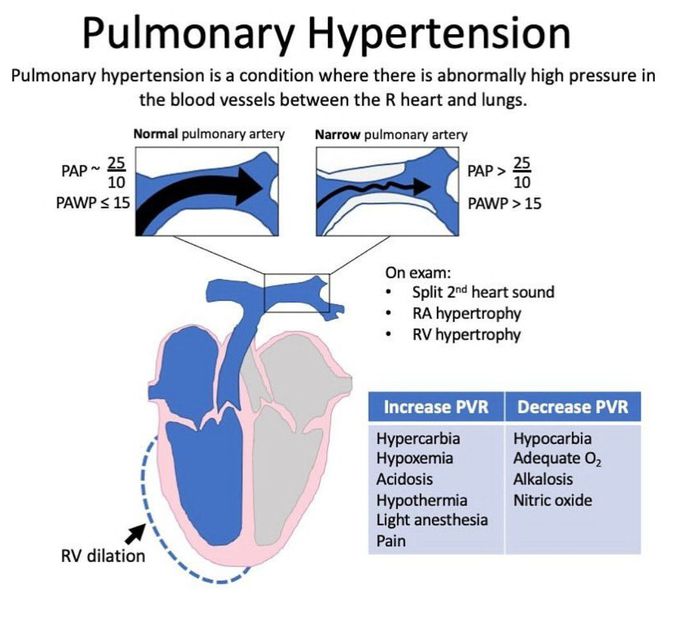 Pulmonary Hypertension