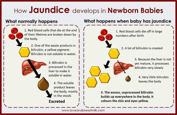 Neonatal jaundice