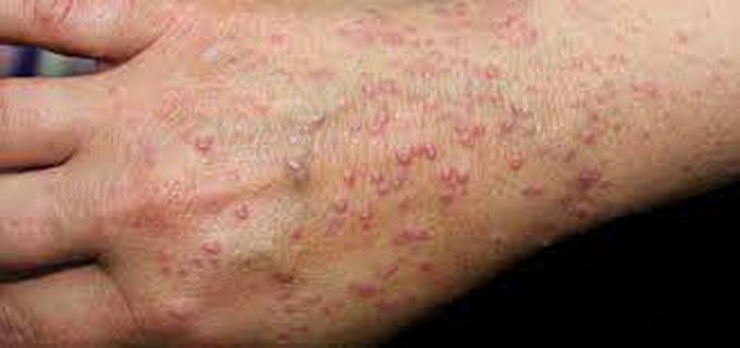 Lichen Planus