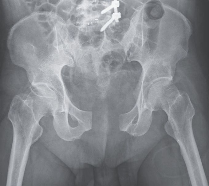 Open-Book Pelvic Fracture